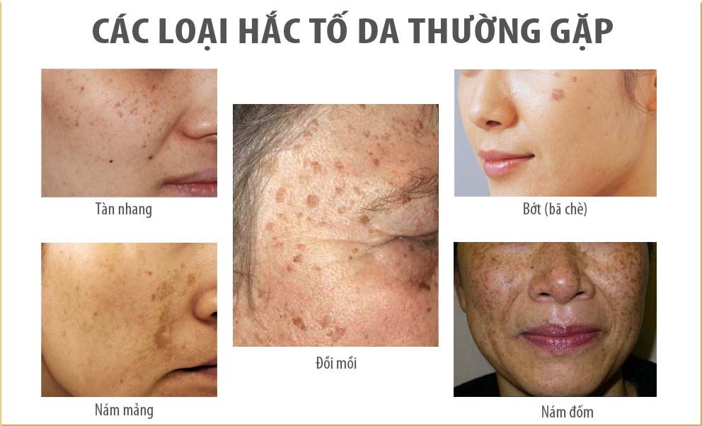 LÃO HÓA DA LÀ GÌ NHỮNG DẤU HIỆU CỦA LÃO HÓA DA - 30